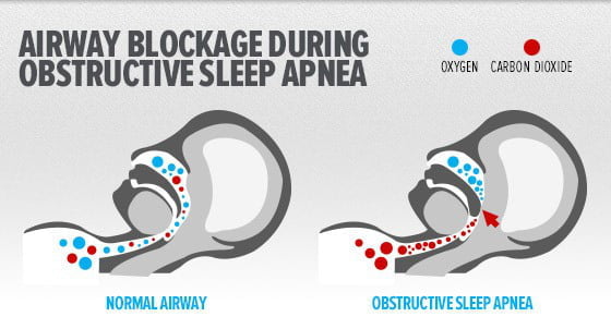 cpapstore-everything you need to know about sleep apnea